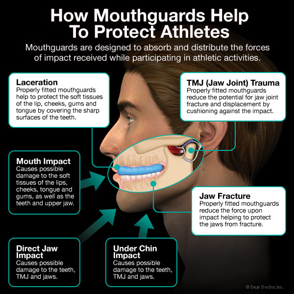 How do mouthguards protect